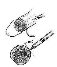 Impotence Alprostadil Injections