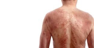 Psoriasis and Impotence - Male With Severe Case on Back